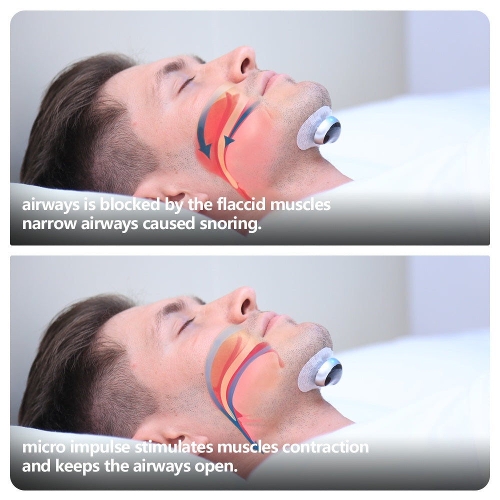 Smart Anti-Snoring Device – Electronic Muscle Stimulator